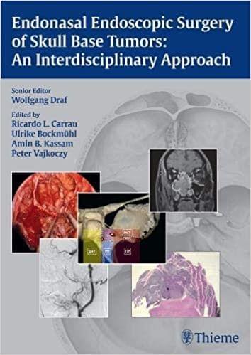 Endonasal Endoscopic Surgery of Skull Base Tumors 1st Edition 2015 By Wolfgang Draf
