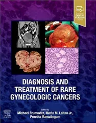 Michael Frumovitz Diagnosis and Treatment of Rare Gynecologic Cancers 2023