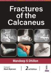 Fractures Of The Calcaneus 2nd Edition 2024 By Mandeep S Dhillon