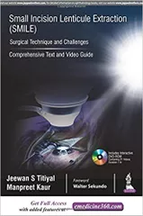 Small Incision Lenticule Extraction SMILE Surgical Technique and Challenges 1st Edition 2018 By Jeewan S Titiyal