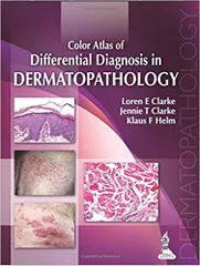 Color Atlas of Differential Diagnosis in Dermatopathology 1st Edition 2014 By Loren E Clarke