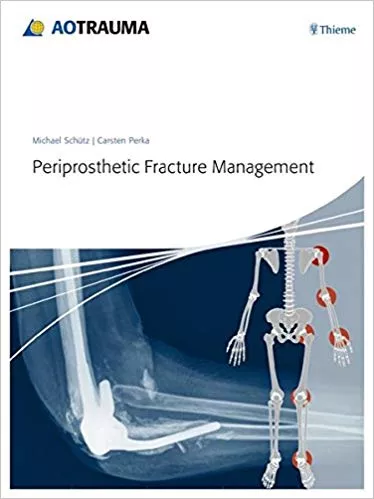 Periprosthetic Fracture Management 1st Edition 2014 By Michael Schuetz