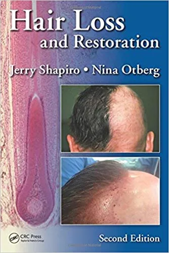 Hair Loss and Restoration 2nd Edition 2015 By Jerry Shapiro