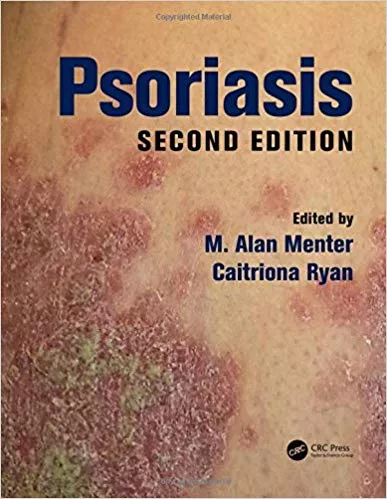 Psoriasis 2nd Edition 2017 By M. Alan Menter