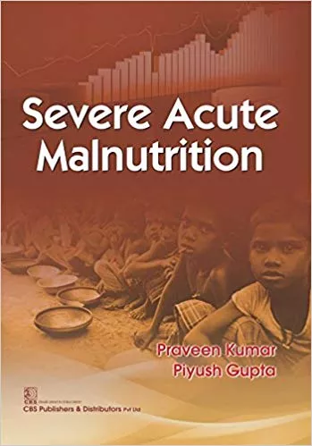Severe Acute Malnutrition 2017 By Kumar P