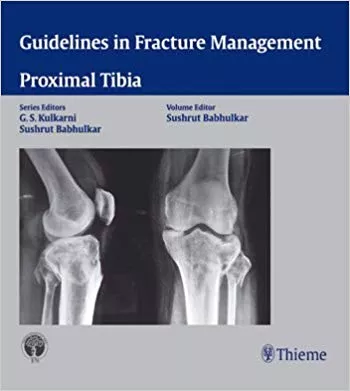 Guidelines in Fracture Management - Proximal Tibia 2014 By Babhulkar