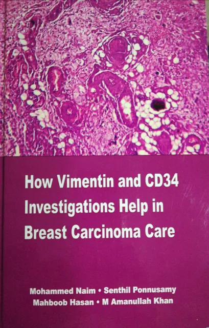 How Vimentin and CD34 Investigations Help In Breast Carcinoma Care by Mohammed Naim, Senthil Ponnusamy, Mahboob Hasan, M Amanullah Khan.